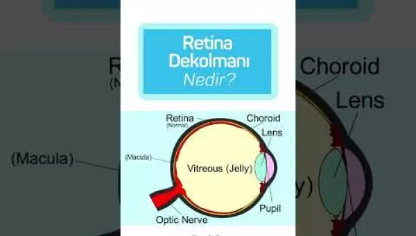 retina,retinacerrahisi,retinadekolmanı,üveit,üveitdoktoru,gözdoktoru,gözhastalıkları,katarakt,katarakttedavisi,gözkızarıklığı,gözkuruluğu,göztansiyonu,konjonktivit,skleral fiksasyon,behçet hastalığı,çocuklarda üveit,sarı nokta,sarı