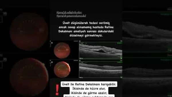 retina,retinahastalıkları,retinadekolmanı,üveit,gözhastalıkları,gözcerrahisi,gözdoktoru