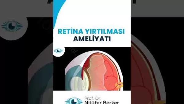 retina,retinacerrahisi,retinadekolmanı,üveit,üveitdoktoru,gözdoktoru,gözhastalıkları,katarakt,katarakttedavisi,gözkızarıklığı,gözkuruluğu,göztansiyonu,konjonktivit,skleral fiksasyon,behçet hastalığı,çocuklarda üveit,sarı nokta,sarı