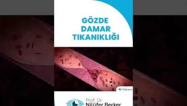 retina,retinacerrahisi,retinadekolmanı,üveit,üveitdoktoru,gözdoktoru,gözhastalıkları,katarakt,katarakttedavisi,gözkızarıklığı,gözkuruluğu,göztansiyonu,konjonktivit,skleral fiksasyon,behçet hastalığı,çocuklarda üveit,sarı nokta,sarı