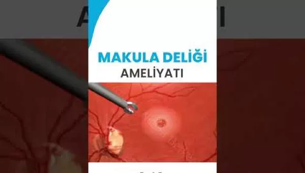 retina,retinacerrahisi,retinadekolmanı,üveit,üveitdoktoru,gözdoktoru,gözhastalıkları,katarakt,katarakttedavisi,gözkızarıklığı,gözkuruluğu,göztansiyonu,konjonktivit,skleral fiksasyon,behçet hastalığı,çocuklarda üveit,sarı nokta,sarı
