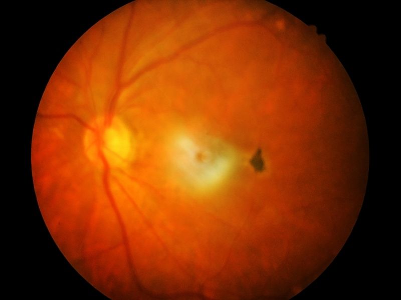 retina-dekolmani-belirtileri