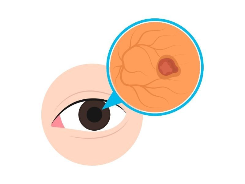 retina-ven-tikanikliginin-belirtileri